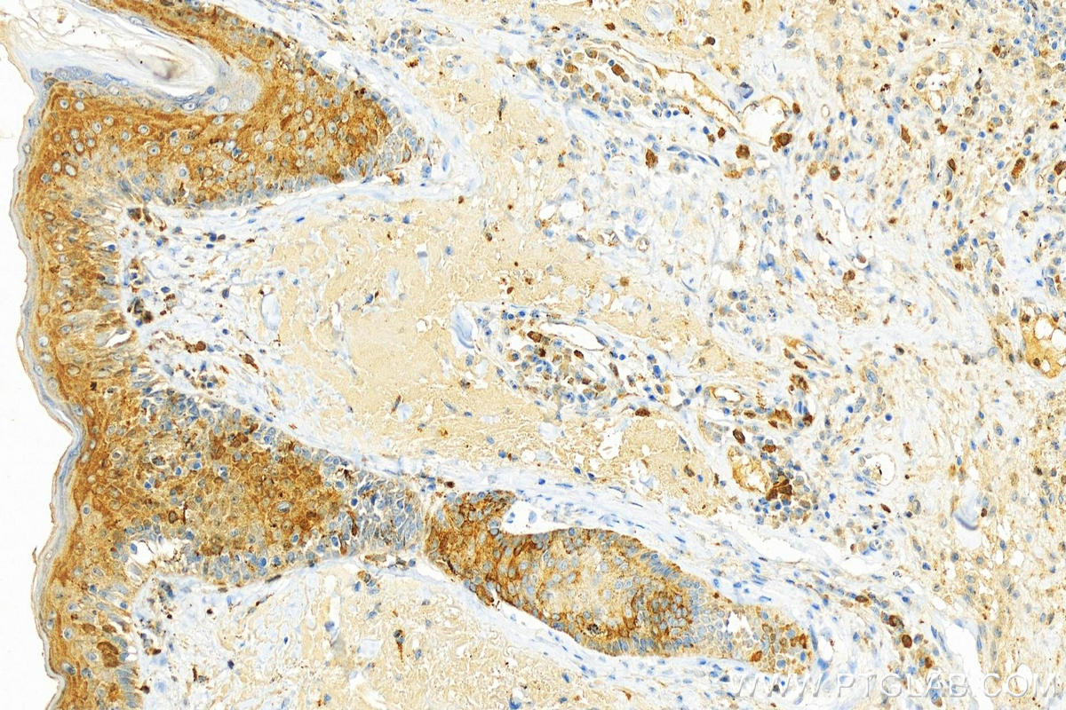 IHC staining of human skin cancer using 13382-1-AP