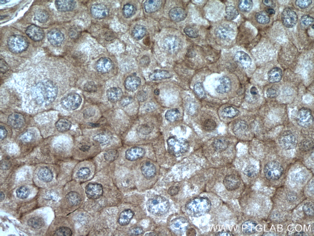 IHC staining of human breast cancer using 15247-1-AP