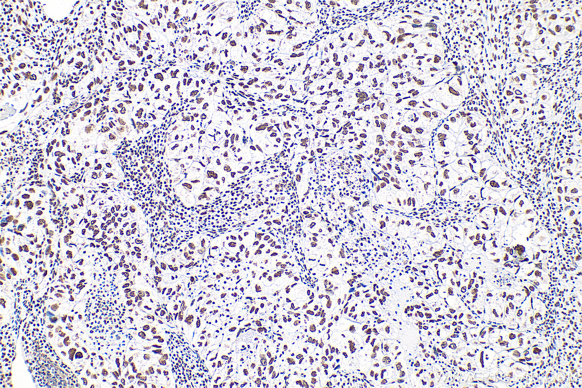 IHC staining of human lung cancer using 83380-1-RR (same clone as 83380-1-PBS)