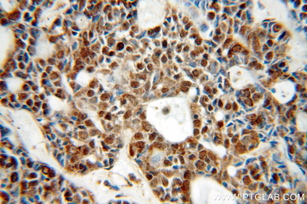 IHC staining of human cervical cancer using 20018-1-AP