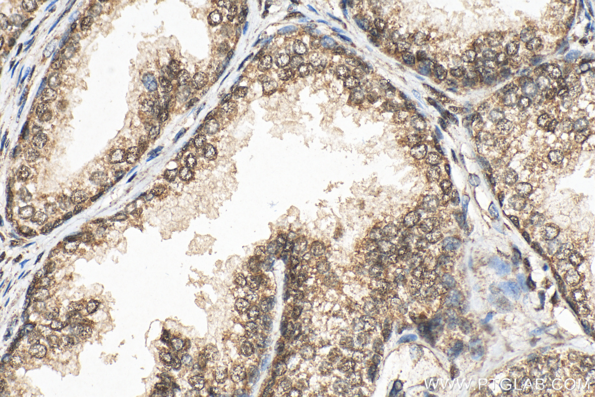 IHC staining of human prostate cancer using 29952-1-AP