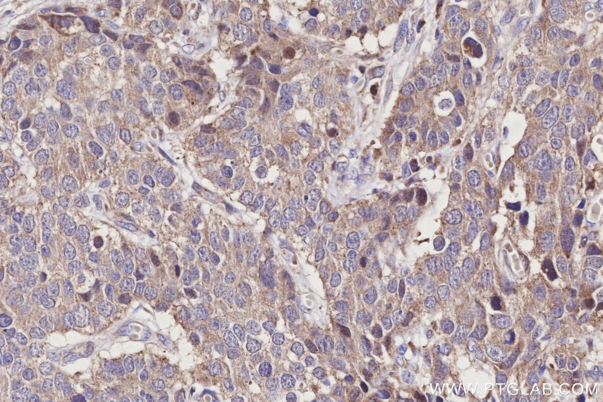 IHC staining of human stomach cancer using 19703-1-AP IHC staining of human stomach cancer using 19703-1-AP