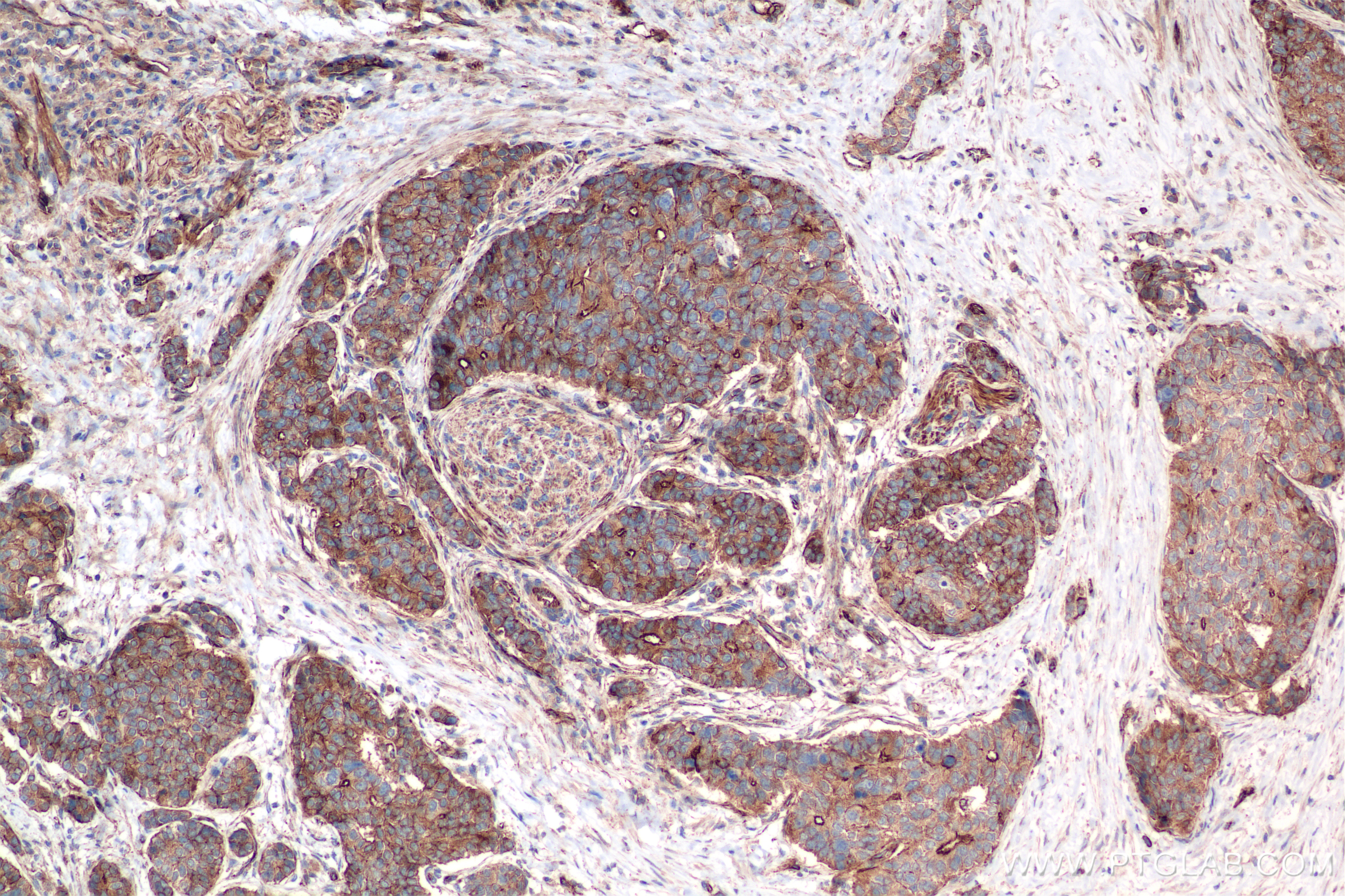 IHC staining of human stomach cancer using 85098-1-RR (same clone as 85098-1-PBS)