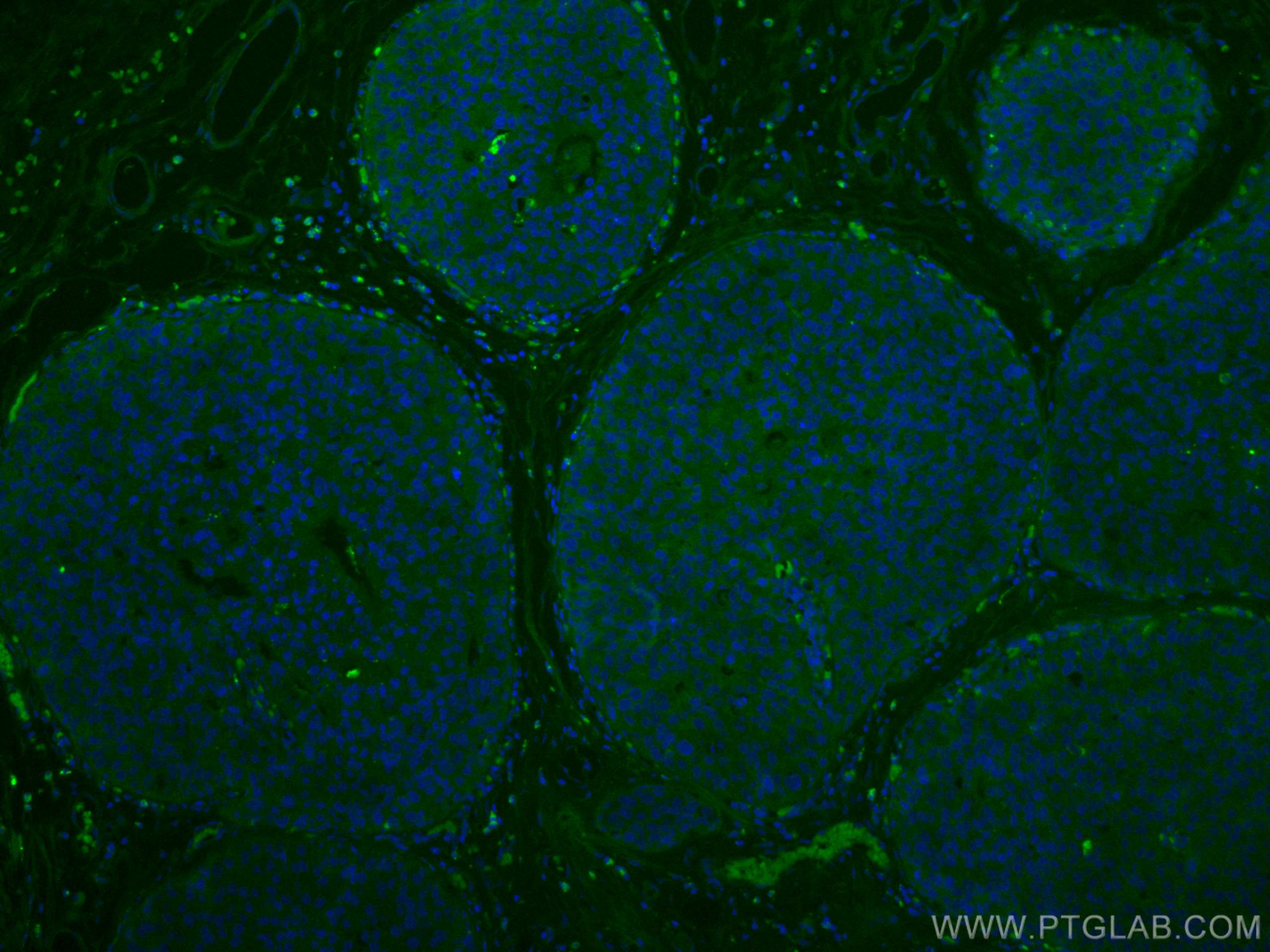 IF Staining of human breast cancer using CL488-10233