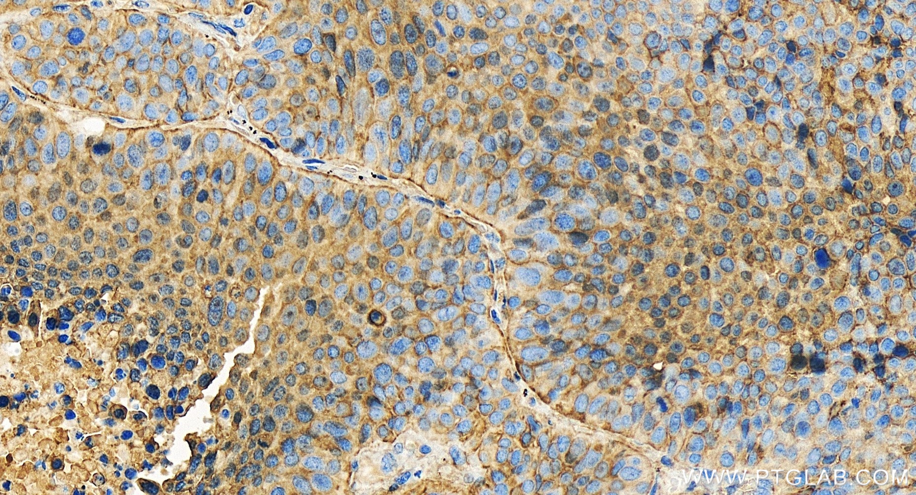 IHC staining of human lung cancer using 85141-4-RR (same clone as 85141-4-PBS)