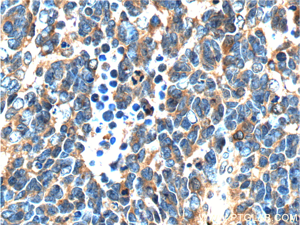 IHC staining of human medulloblastoma using 12184-1-AP