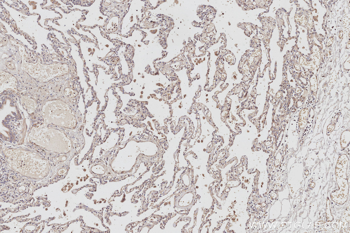 IHC staining of human lung cancer using 12184-1-AP IHC staining of human lung cancer using 12184-1-AP
