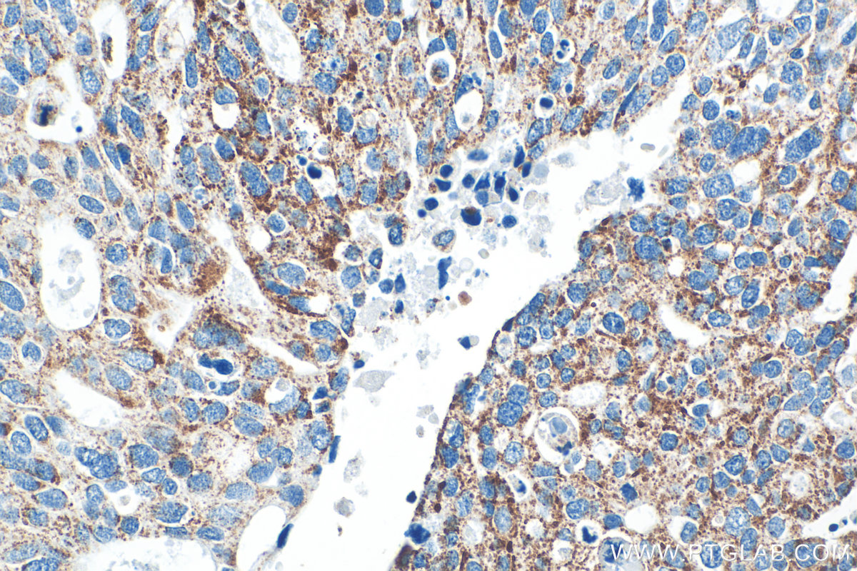 IHC staining of human ovary tumor using 32947-1-AP (same clone as 32947-1-PBS) IHC staining of human ovary tumor using 32947-1-AP (same clone as 32947-1-PBS)