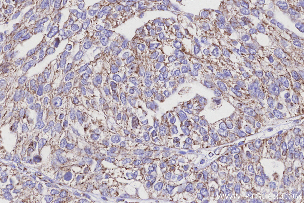 IHC staining of human ovary cancer using 32947-1-AP