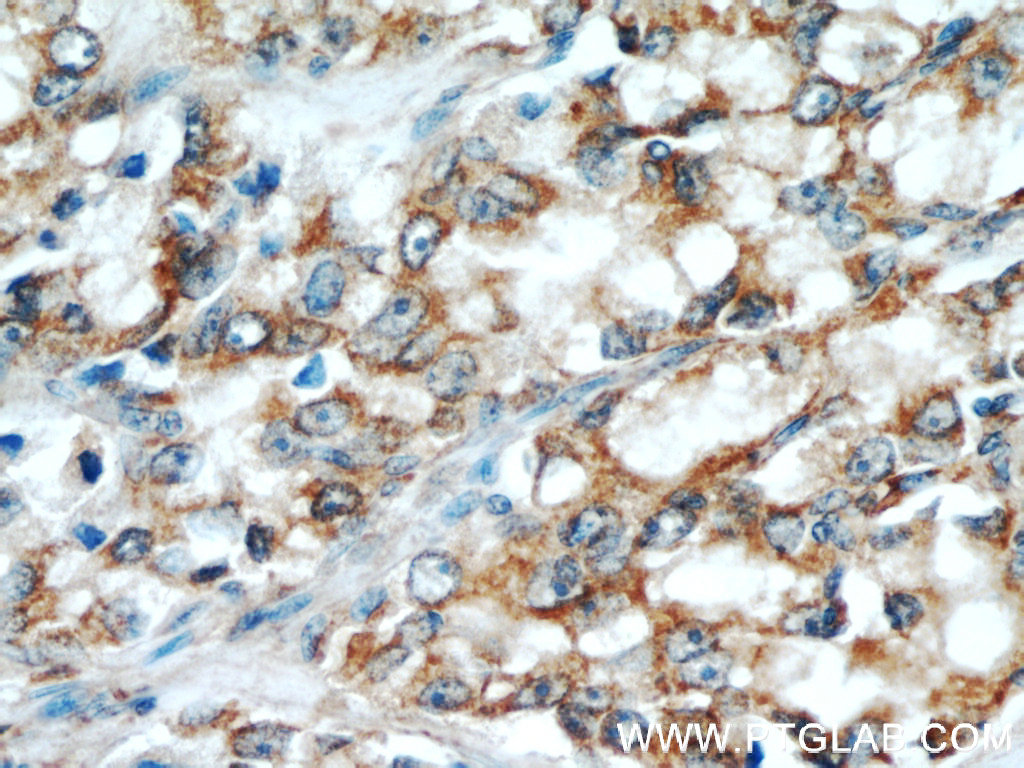IHC staining of human prostate cancer using 10986-1-AP