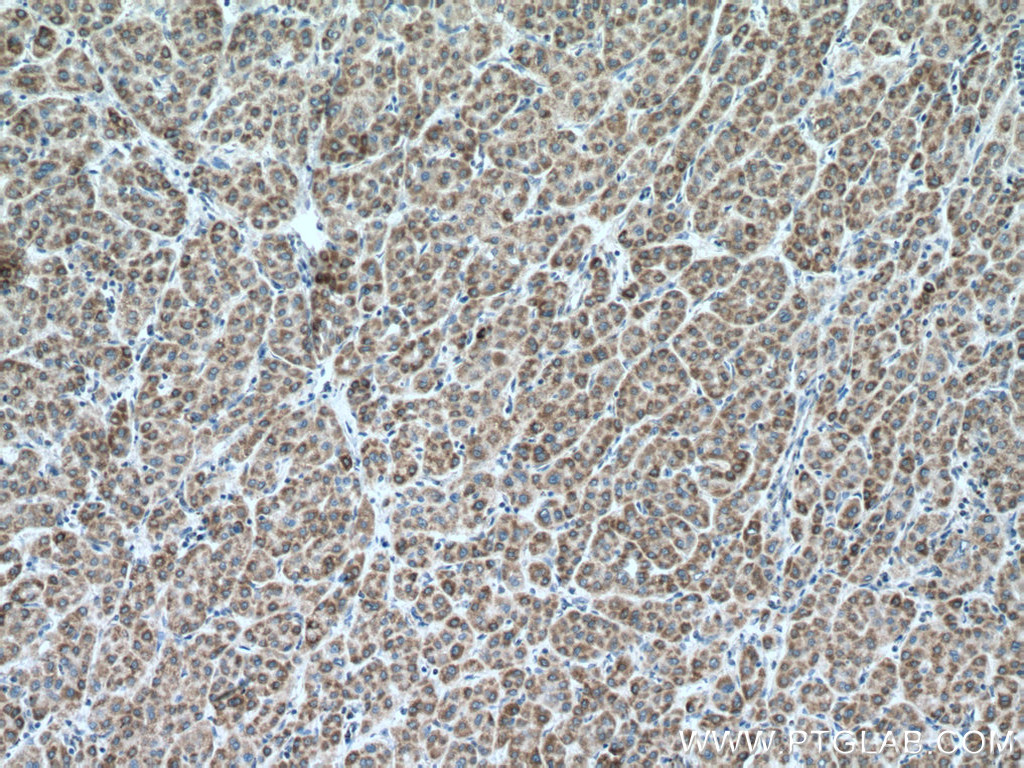 IHC staining of human liver cancer using 16480-1-AP