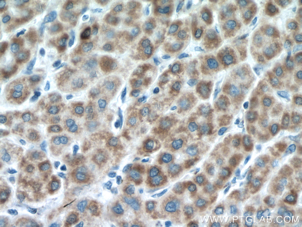 IHC staining of human liver cancer using 16480-1-AP