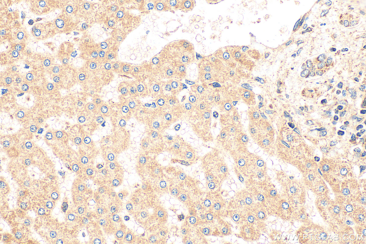 IHC staining of human hepatocirrhosis using 29621-1-AP