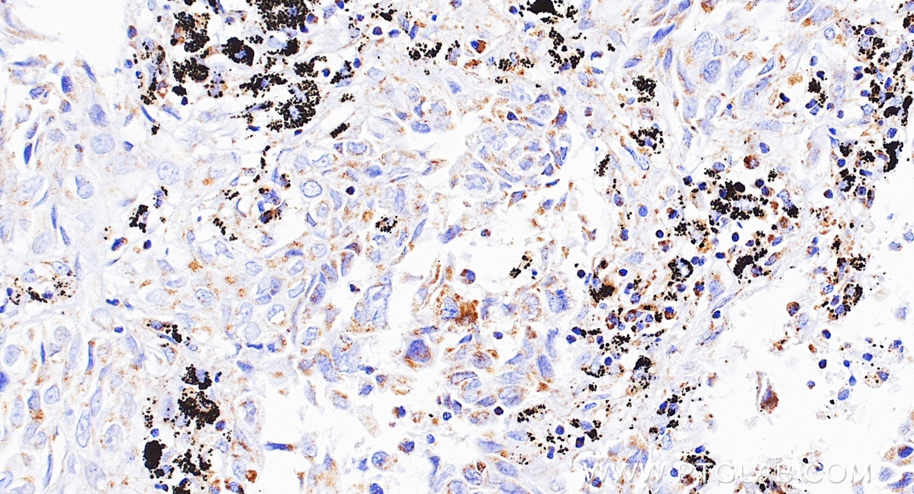 IHC staining of Human lung cancer (Adenocarcinoma) using 87143-2-RR IHC staining of Human lung cancer (Adenocarcinoma) using 87143-2-RR
