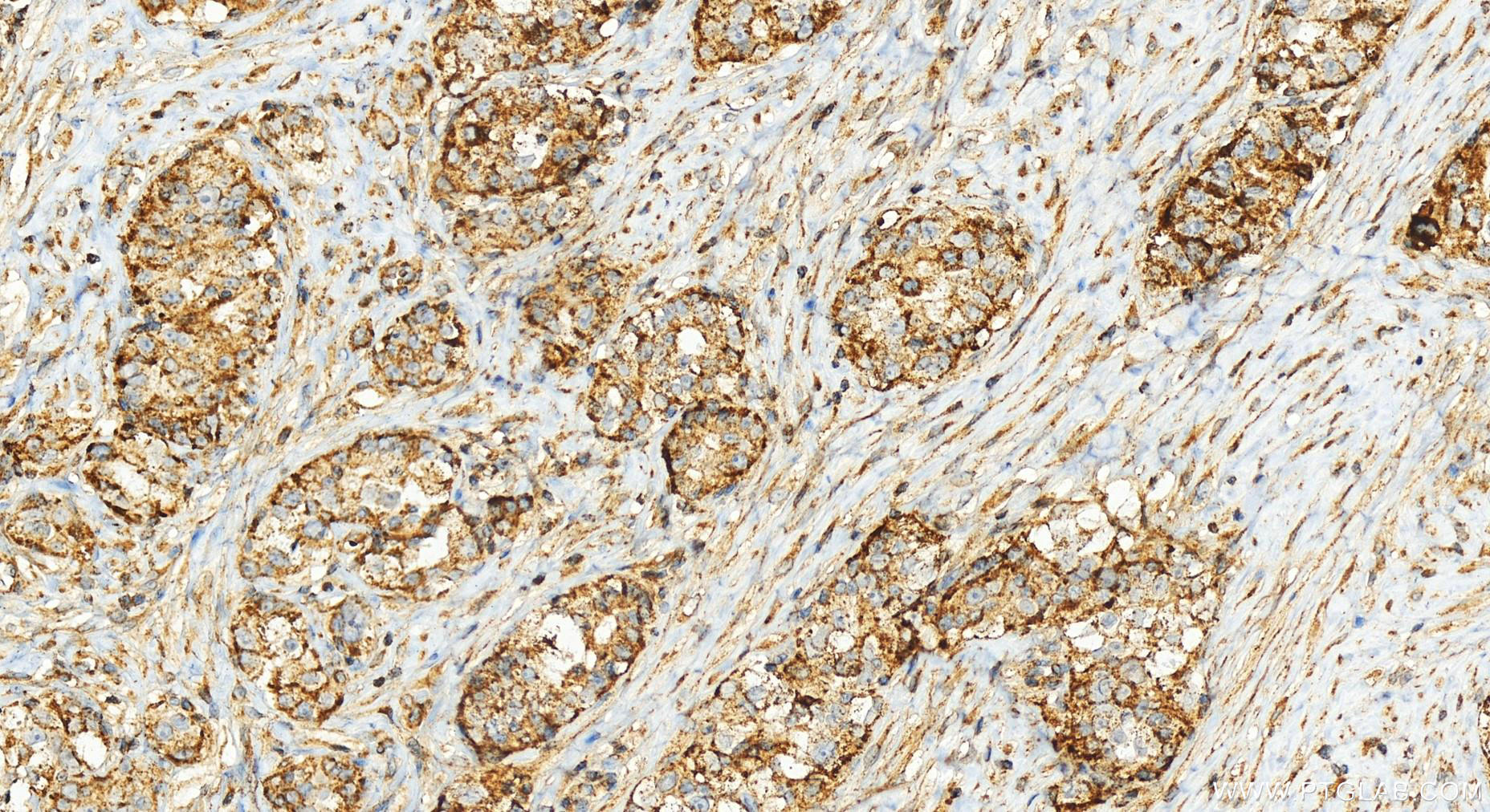 IHC staining of human ovary cancer using 25621-1-AP
