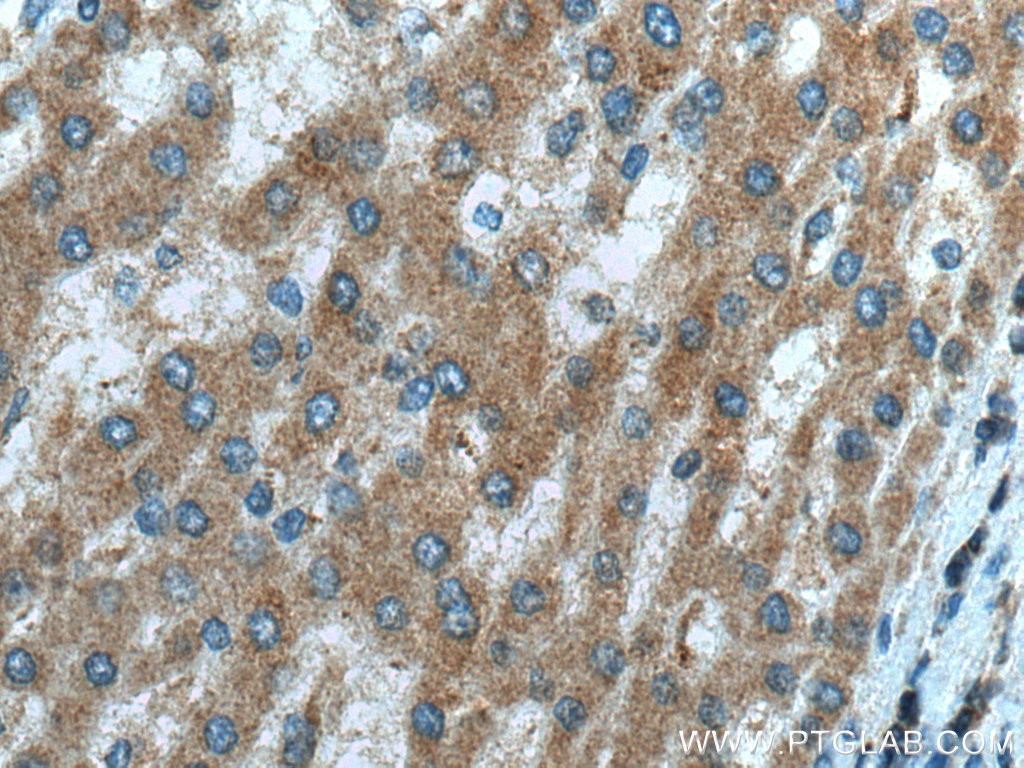 IHC staining of human liver cancer using 12358-1-AP