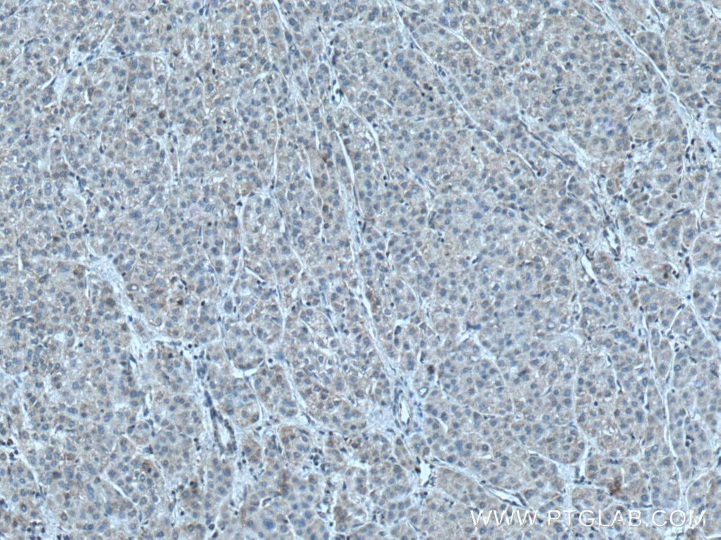 IHC staining of human liver cancer using 16037-1-AP