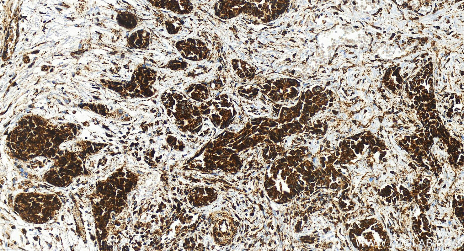 IHC staining of human intrahepatic cholangiocarcinoma using 83216-3-RR (same clone as 83216-3-PBS)
