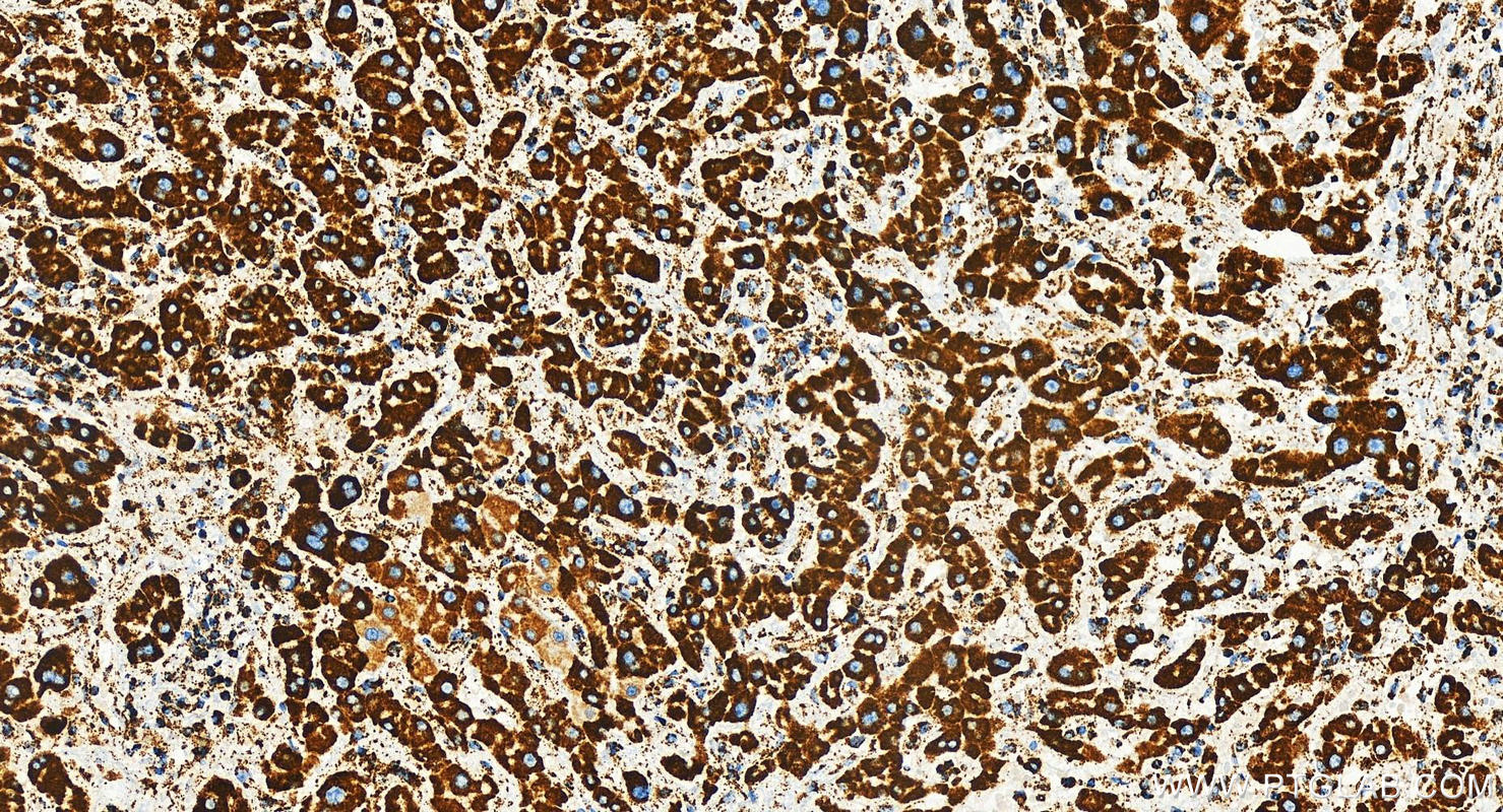 IHC staining of human intrahepatic cholangiocarcinoma using 83216-4-RR (same clone as 83216-4-PBS)