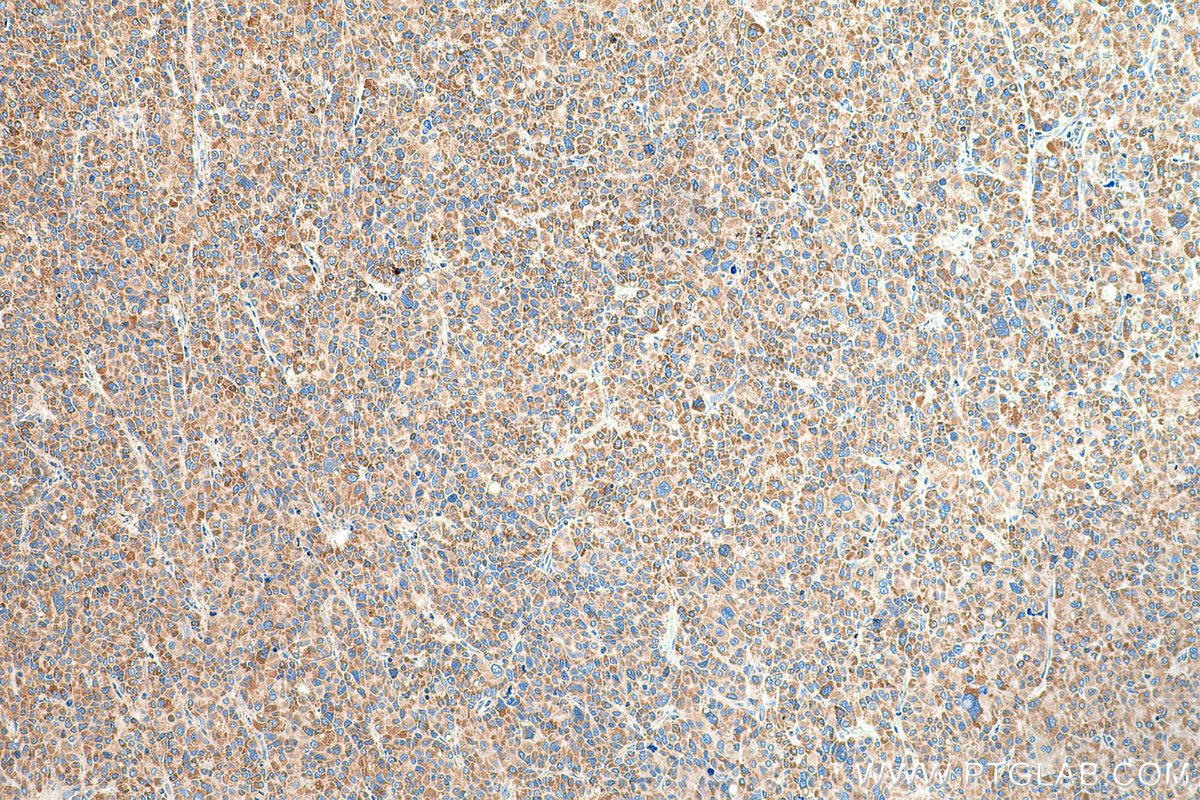 IHC staining of human liver cancer using 12444-1-AP