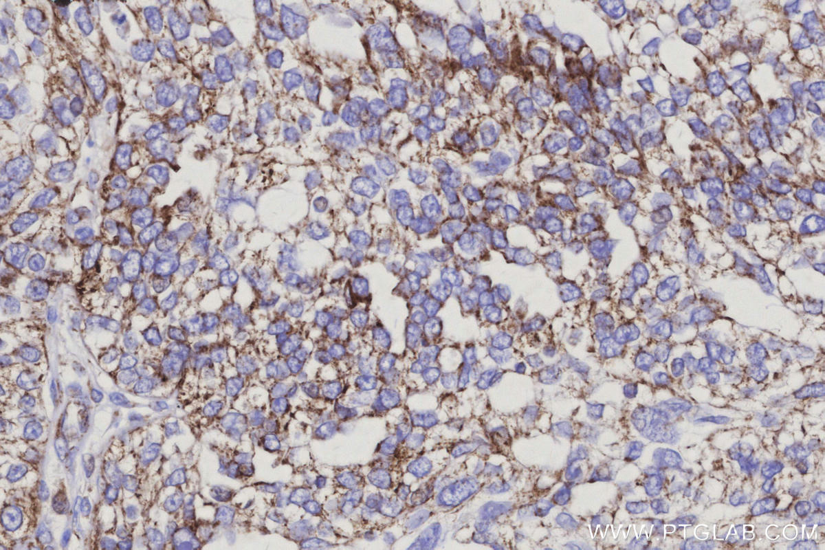 IHC staining of human ovary cancer using 66053-1-Ig