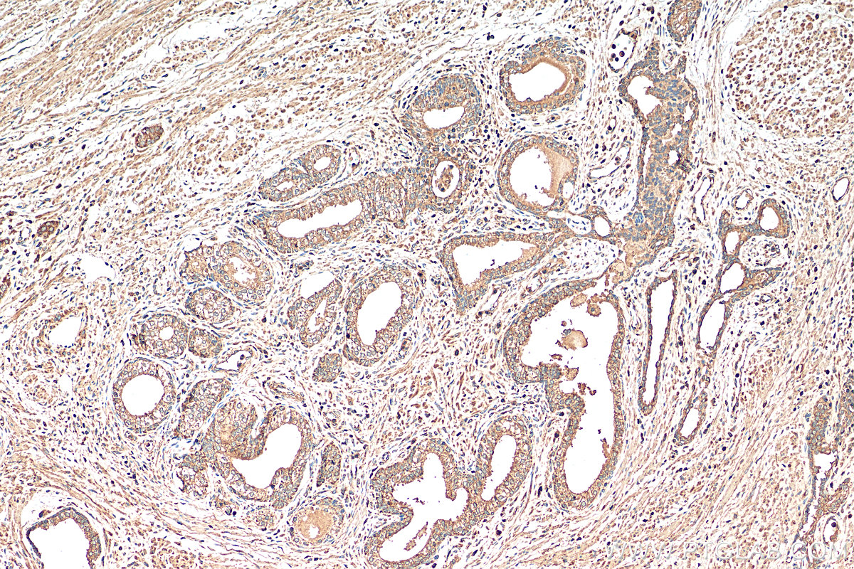 IHC staining of human prostate cancer using 68329-1-Ig