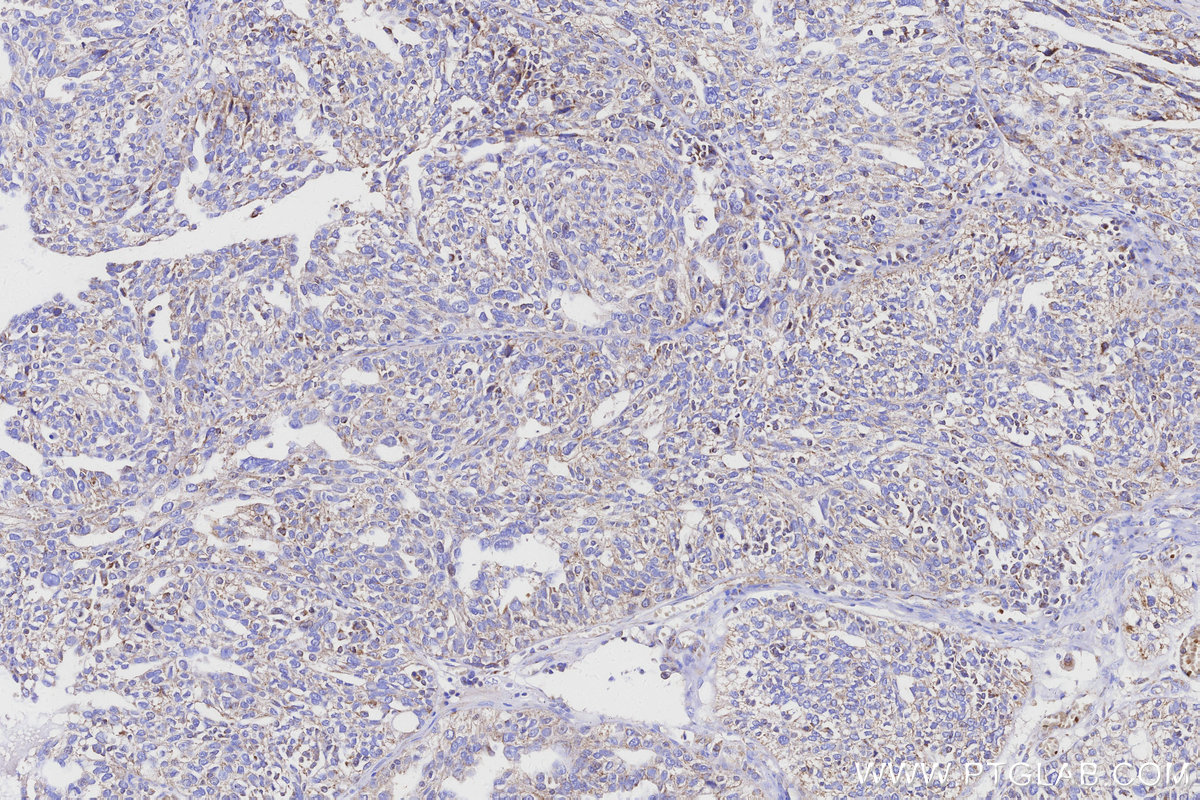 IHC staining of human ovary cancer using 68329-1-Ig IHC staining of human ovary cancer using 68329-1-Ig