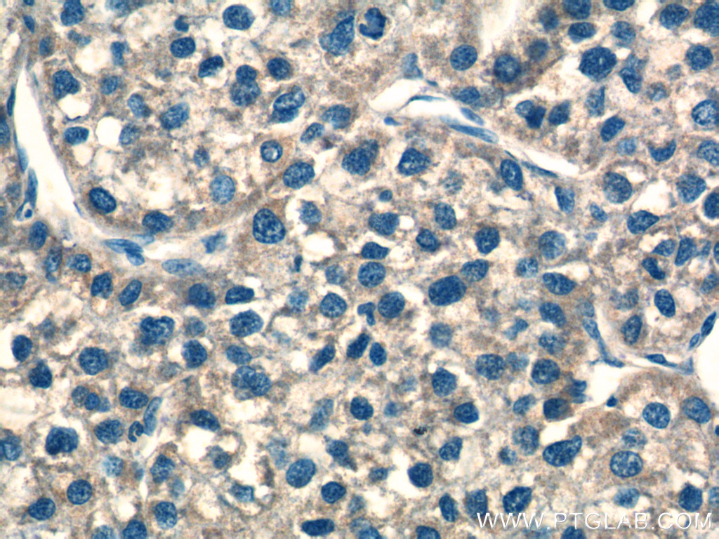 IHC staining of human liver cancer using 25172-1-AP