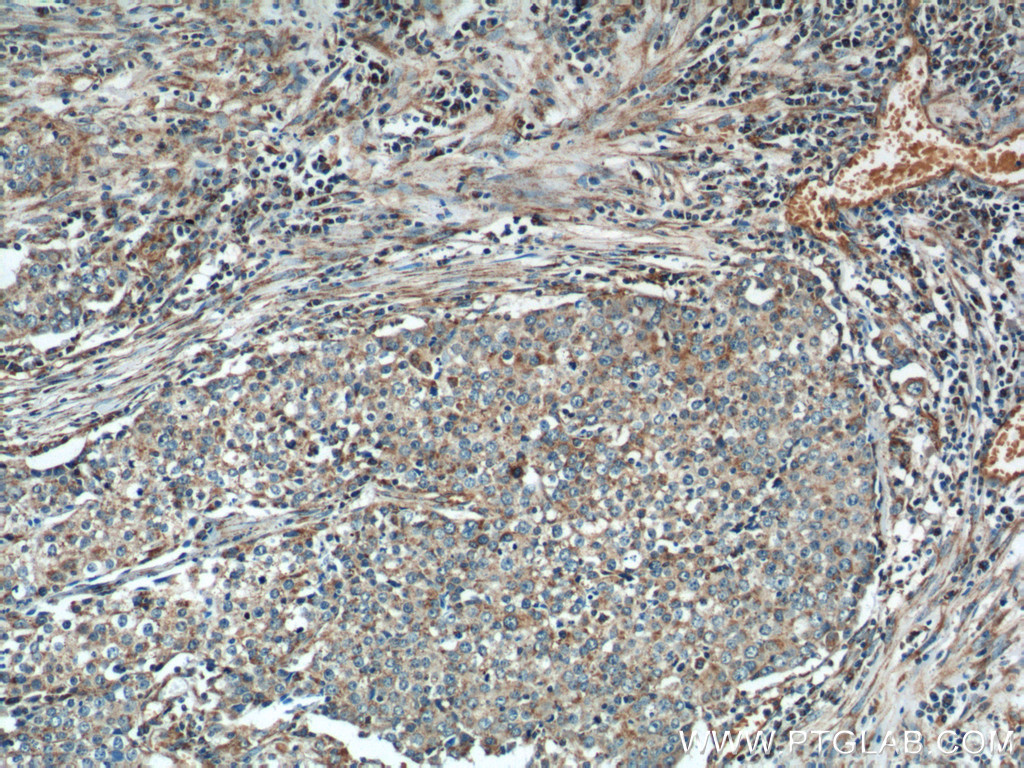 IHC staining of human lung cancer using 11238-1-AP