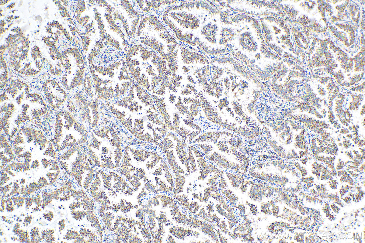 IHC staining of human lung cancer using 68144-1-Ig