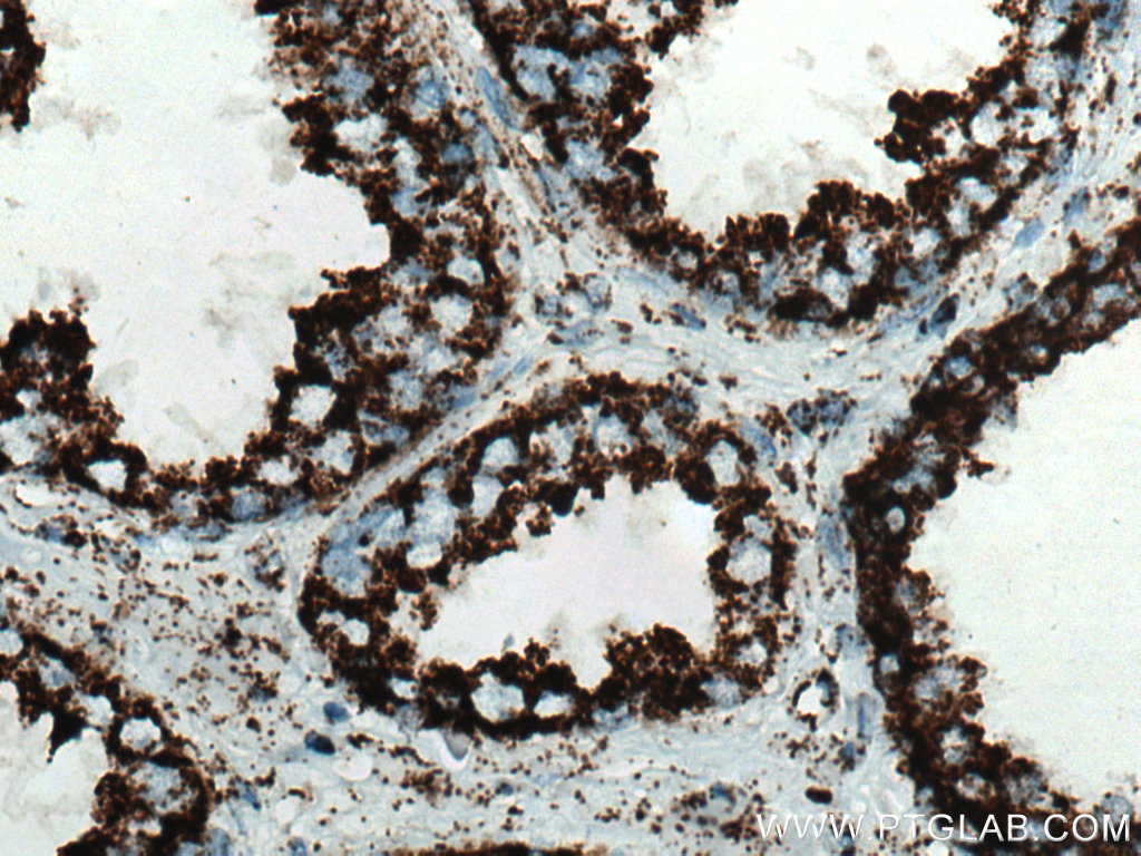 IHC staining of human prostate cancer using 15301-1-AP