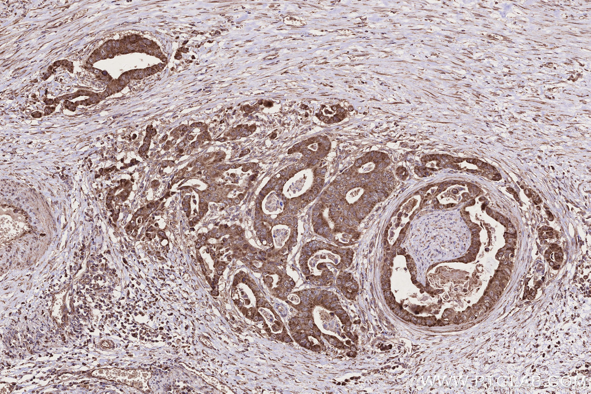 IHC staining of human stomach cancer using 13993-1-AP