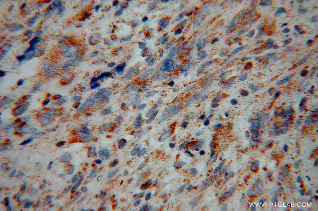 IHC staining of human gliomas using 13993-1-AP
