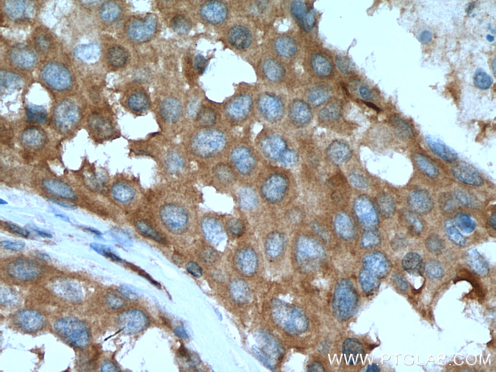 IHC staining of human breast cancer using 21698-1-AP