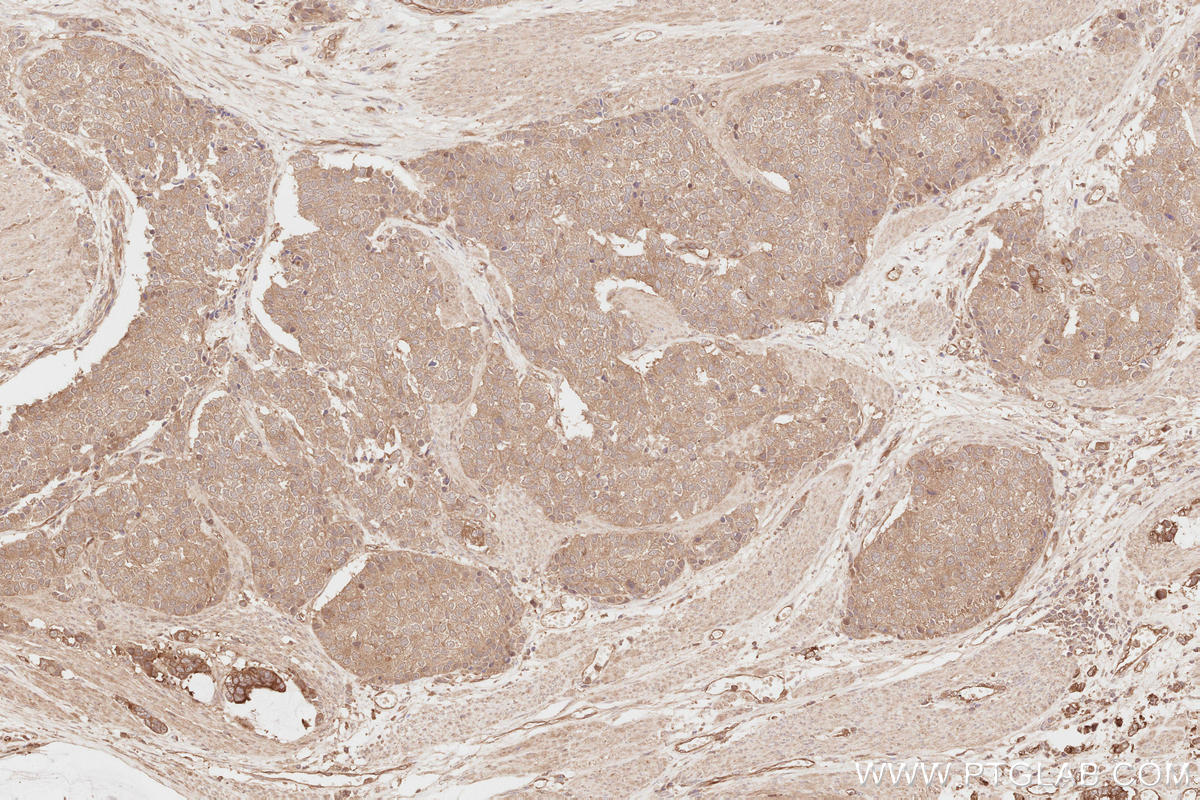 IHC staining of human stomach cancer using 13690-1-AP