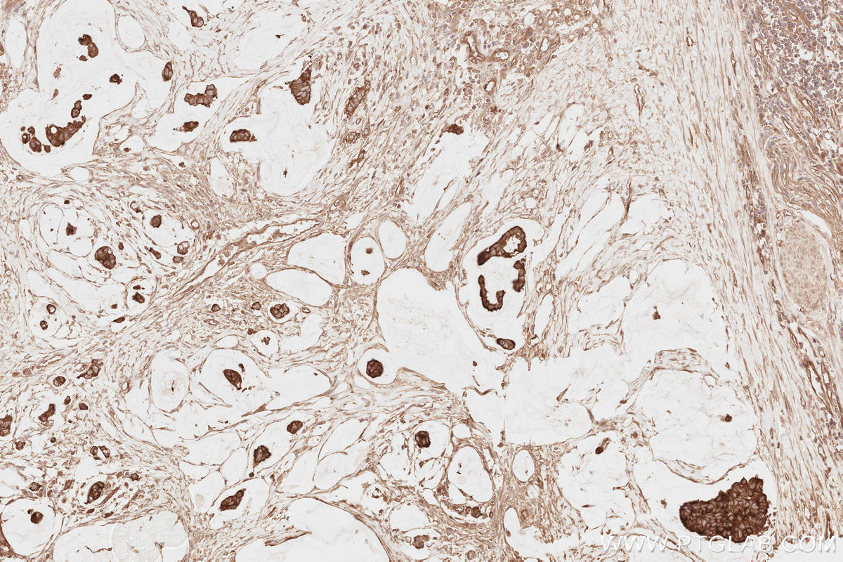 IHC staining of human stomach cancer using 13690-1-AP