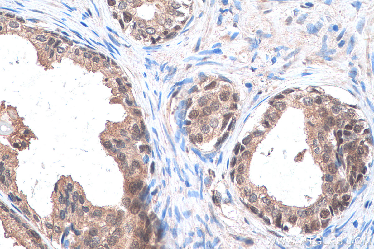 IHC staining of human prostate cancer using 16777-1-AP