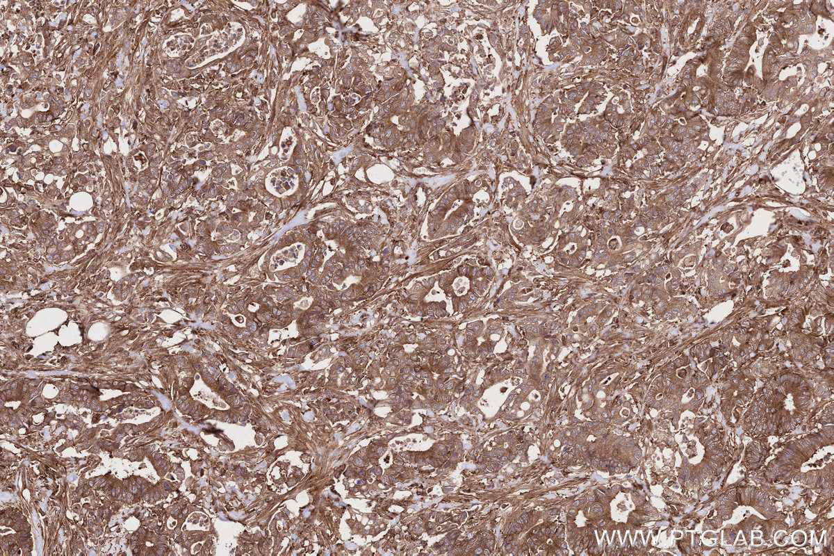 IHC staining of human rectal cancer using 11192-1-AP IHC staining of human rectal cancer using 11192-1-AP