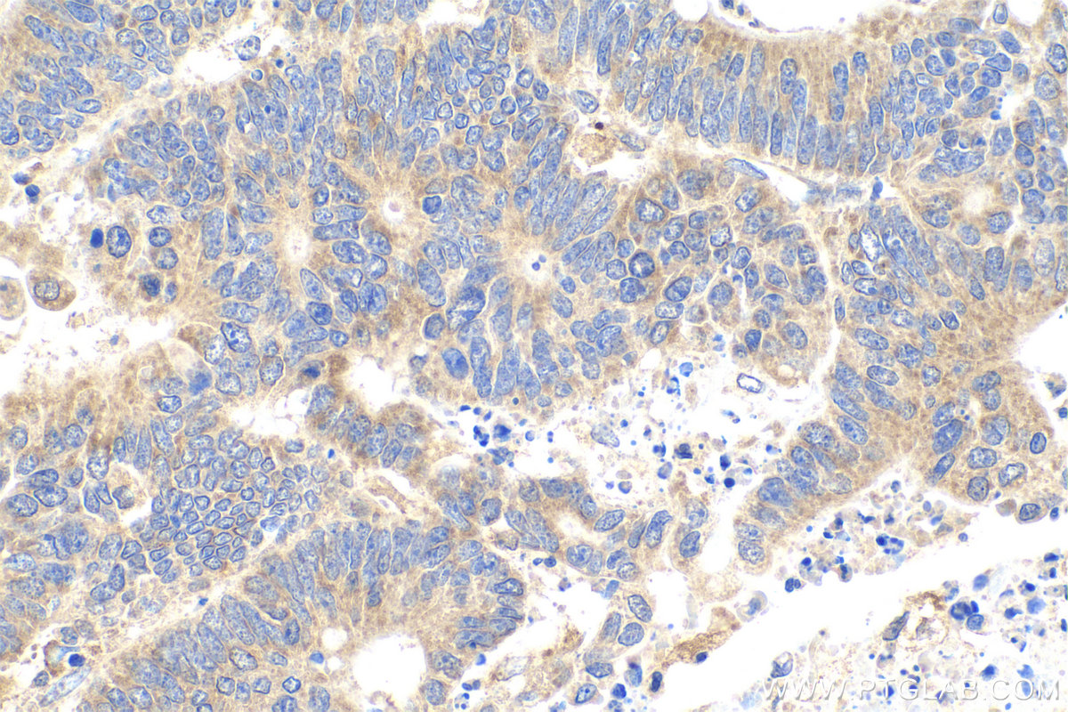 IHC staining of human colon cancer using 60131-1-Ig