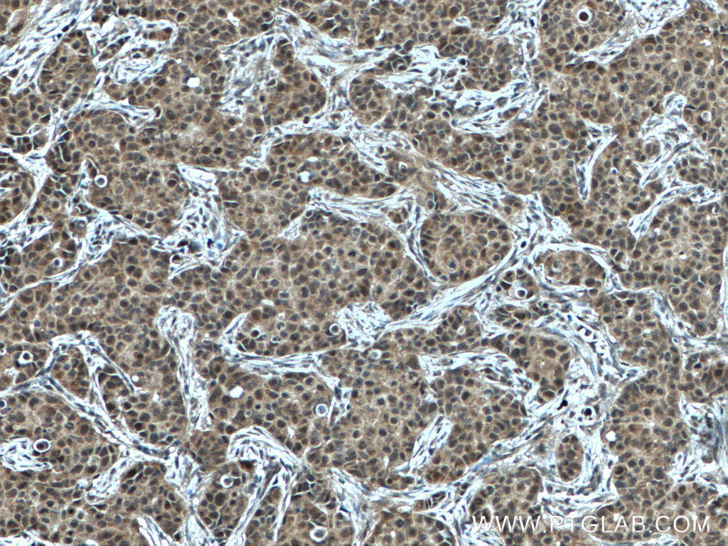 IHC staining of human breast cancer using 28180-1-AP