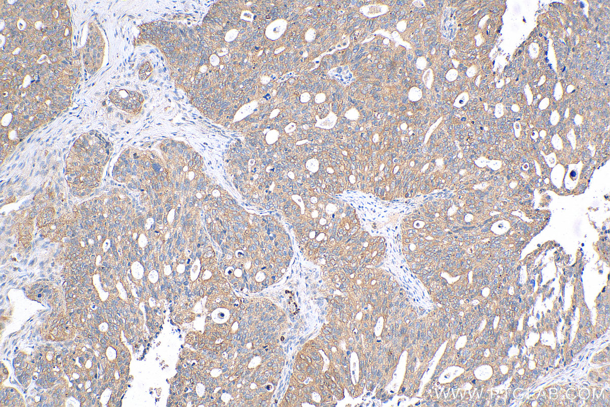 IHC staining of human ovary tumor using 29936-1-AP
