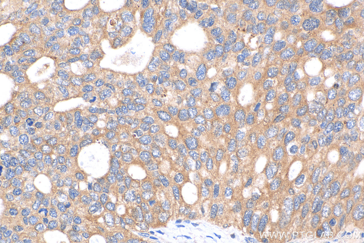 IHC staining of human ovary tumor using 29936-1-AP