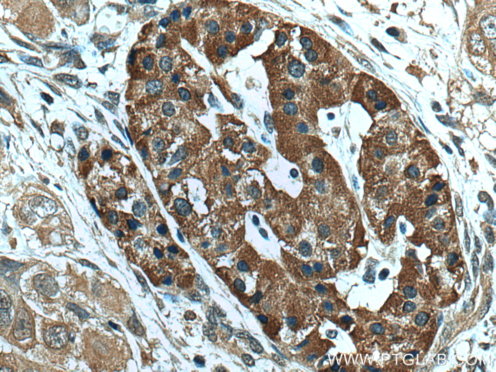 IHC staining of human pancreas cancer using 67098-1-Ig