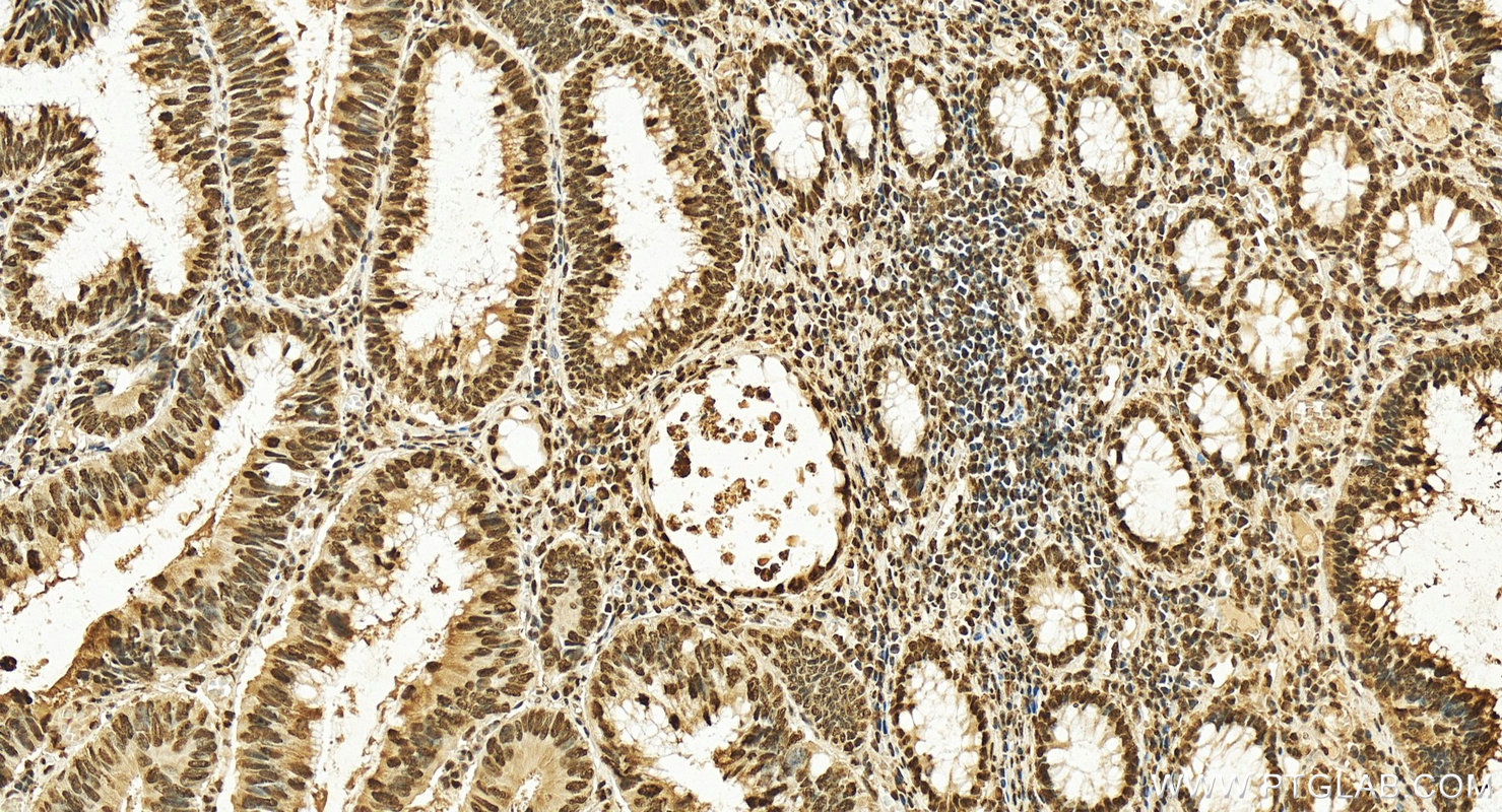 IHC staining of human colon cancer using 14714-1-AP