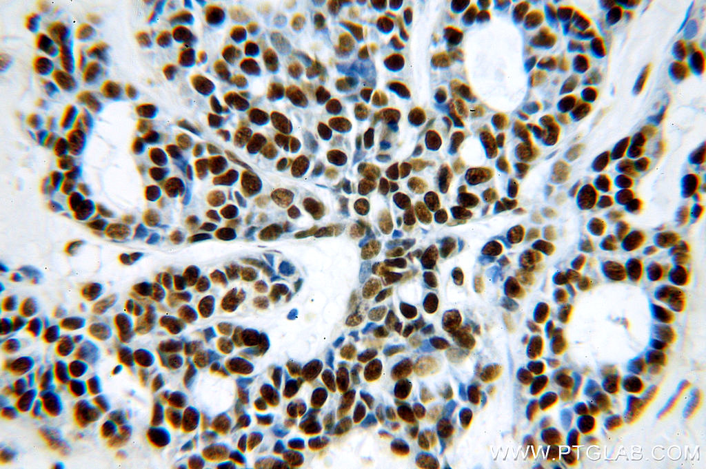 IHC staining of human cervical cancer using 19887-1-AP