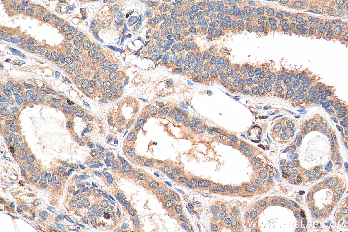 IHC staining of human breast cancer using 22023-1-AP