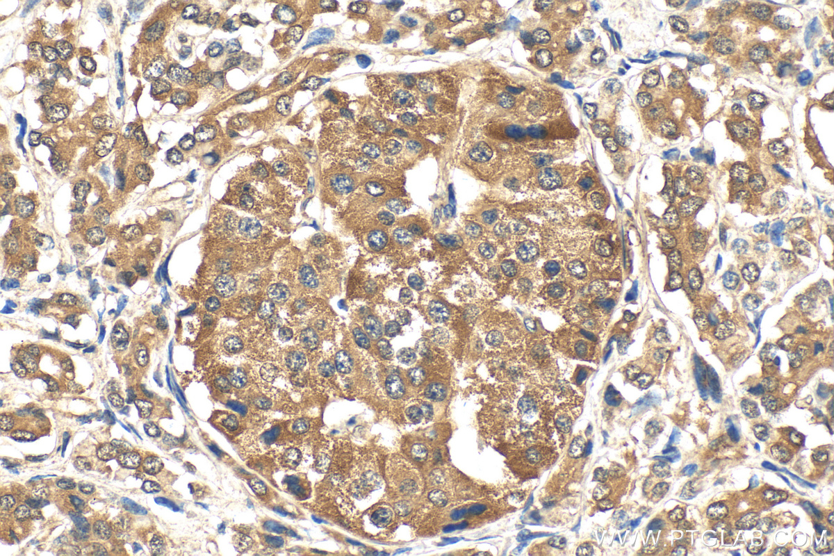 Immunohistochemical analysis of paraffin-embedded human pancreas cancer tissue slide using 16396-1-AP (NRF2, NFE2L2 antibody) at dilution of 1:200 (under 40x lens). Heat mediated antigen retrieval with Tris-EDTA buffer (pH 9.0). IHC staining of human pancreas cancer using 16396-1-AP