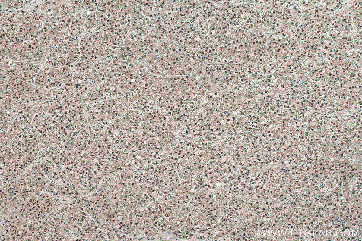 IHC staining of human liver cancer using 16399-1-AP
