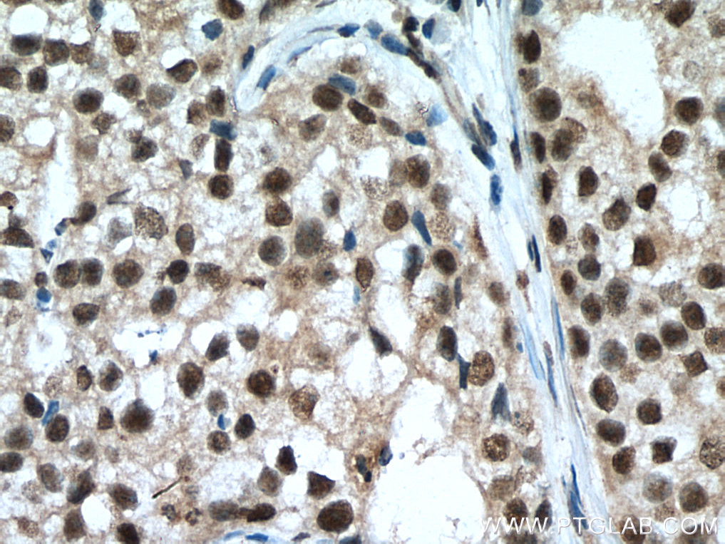 IHC staining of human breast cancer using 66992-1-Ig