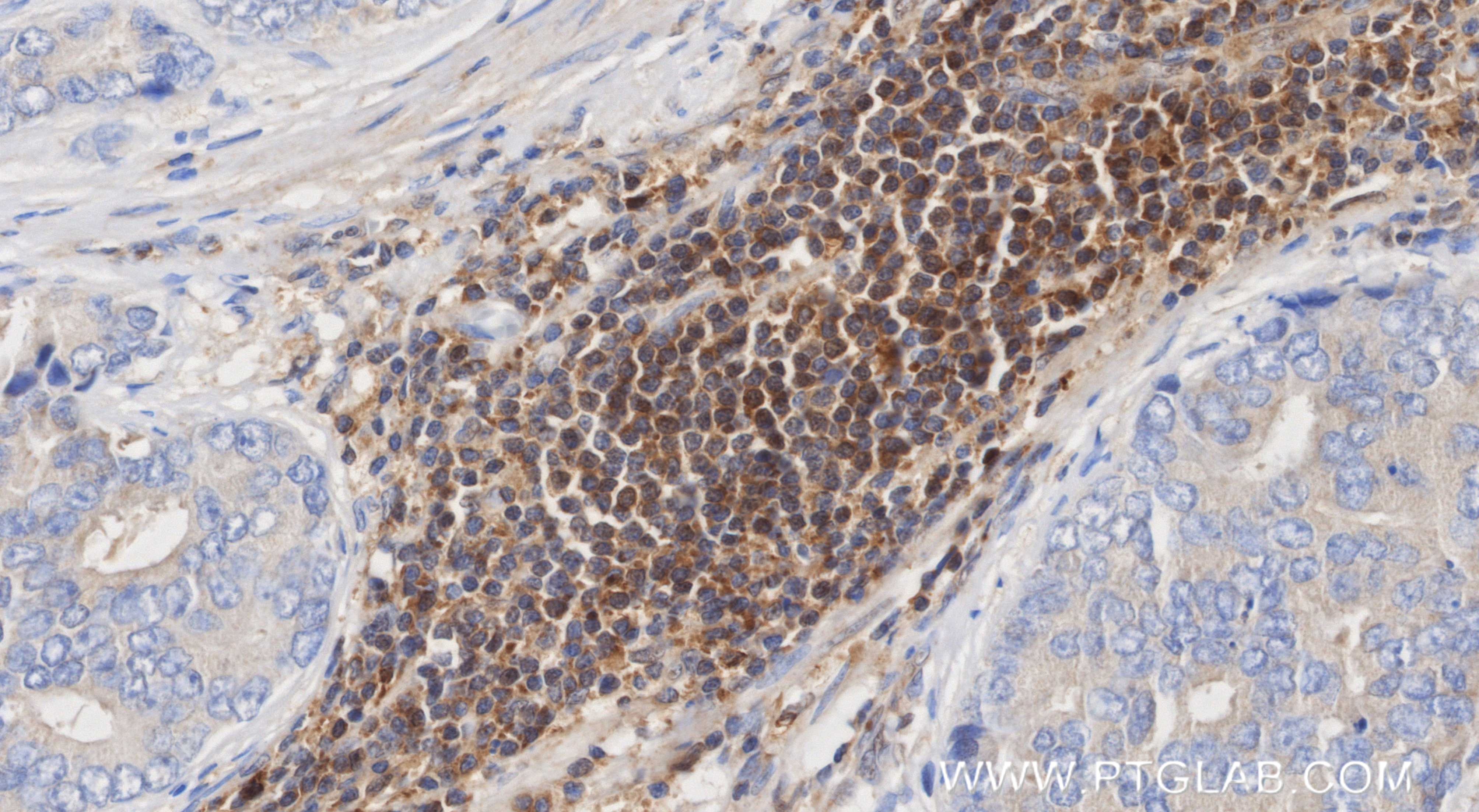 Immunohistochemical analysis of paraffin-embedded human prostate cancer tissue slide using <a class='green' href='/productredirect?CatalogNo=81261-2-RR' target='_blank'>81261-2-RR</a> (NFKB1 p105/p50-Specific antibody) at dilution of 1:1000 (under 40x lens). Heat mediated antigen retrieval with Tris-EDTA buffer (pH 9.0). This data was developed using the same antibody clone with 81261-2-PBS in a different storage buffer formulation. IHC staining of human prostate cancer using 81261-2-RR (same clone as 81261-2-PBS)